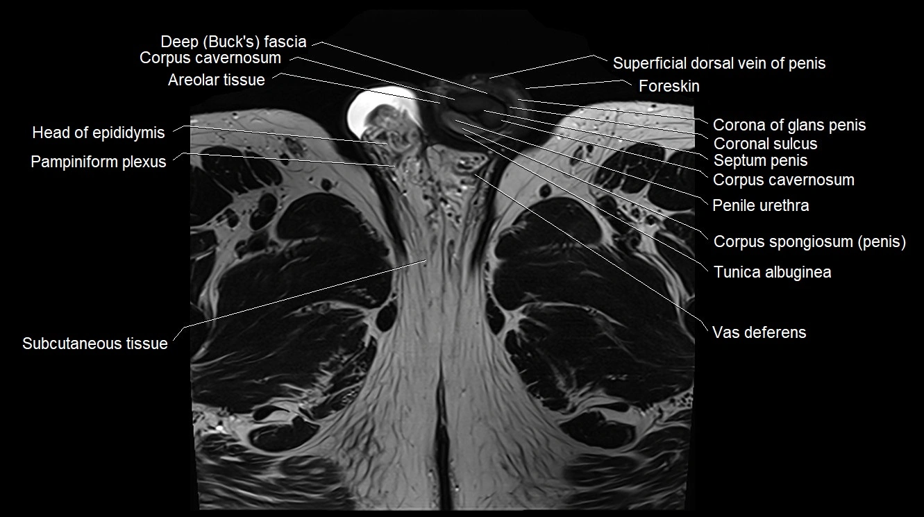 MRI 3T scrotum and penis axial cross sectional anatomy image 27.webp